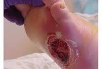 Signs and Symptoms of Wound Infection British Columbia Provincial Nurses Skin and Wound Committee Education Module: Conservative Sharp Wound Debridement 49, 60 INFECTED WOUNDS Increasing severity of
