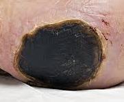 British Columbia Provincial Nurses Skin and Wound Committee Education Module: Conservative Sharp Wound Debridement Dry stable eschar Unstable, Dry Boggy Eschar Dry stable eschar is