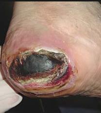 It can be present in any type of wound. 8 Non healable and healable arterial wounds on the lower leg that are covered with dry stable eschar should not be debrided.