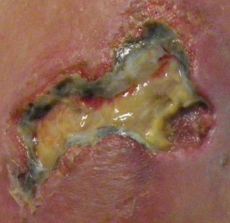 Stable, non infected, heel ulcers covered with dry eschar should not be debrided unless they show signs of infection such as fluctuance, edema, erythema and drainage.