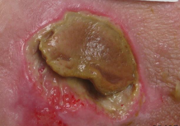 If dry eschar begins to lift or becomes unstable, moist or boggy, consult a wound clinician and / or physician / NP to determine if debridement is indicated.