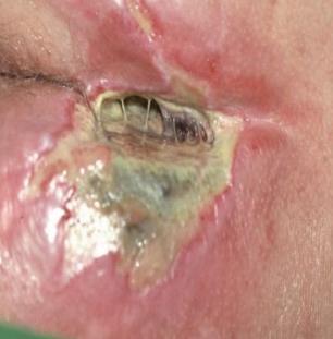 systemic infection. 2. Reduces the effect of topical antimicrobials. 3.