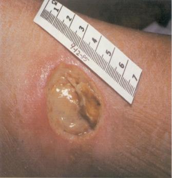 Interferes with the ability of white cells to clear bacteria and debris from the wound. 5.
