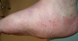 They are the result of excessive skin buildup which is a protective function of the epidermis in response to uncorrected high pressure over bony prominences on the foot.