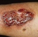 Exposed bone in the wound Deep wound infection CSWD is contraindicated if: The client does not consent to CSWD.