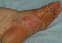 There is a below-knee, non-infected, ischemic ulcer, covered with dry, stable eschar and the goal of care wound stability rather than healing, e.g. an arterial ulcer or a diabetic ulcer with dry gangrene.