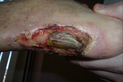 The heel region and bottom of the foot can be debrided. 12, 16, 29 Wet or dry gangrene is present. It is not possible to fully access or visualize the wound.