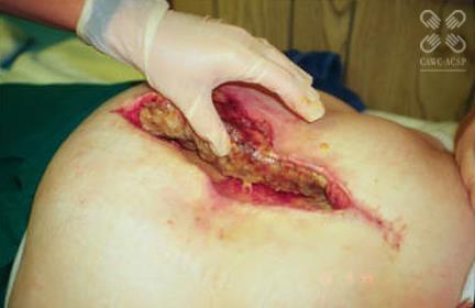 Education Module: Use of Conservative Sharp Wound Debridement Case Study #3 Mrs. Clarke sees you in the clinic following a recent caesarian section.