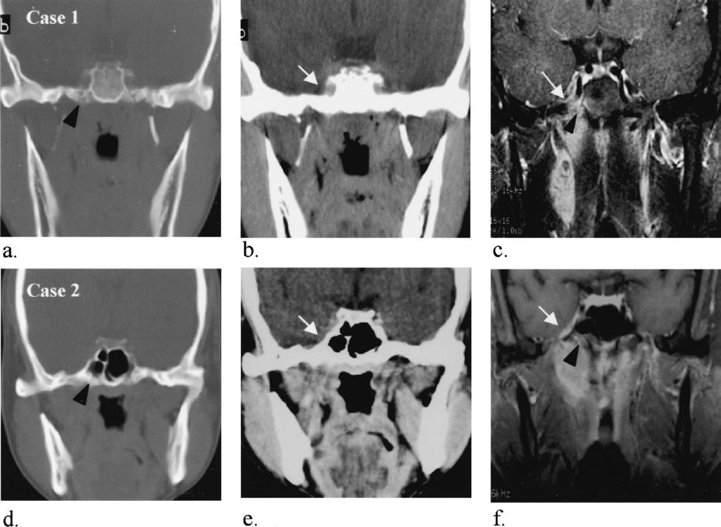 FIGURE 1. CT versus MRI for evaluation of equivocal intracranial lesion and bony destruction (case 1 [a, b, c] and case 2 [d, e, f]).