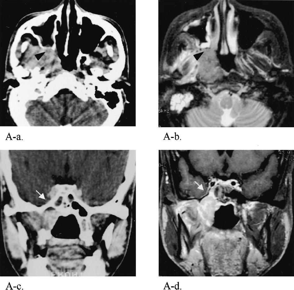 FIGURE 2. (A) NPC tumor with right pterygopalatine fossa invasion (black arrowhead) in axial view by CT (A-a) and MRI (A-b).