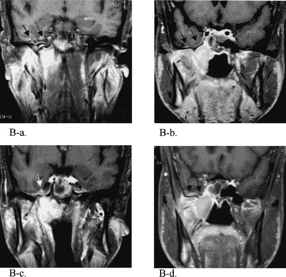 (B) Series of coronal MRI sections of the same patient in (A) with right intracranial invasion. Further clarification of the (A-d) intracranial lesion.