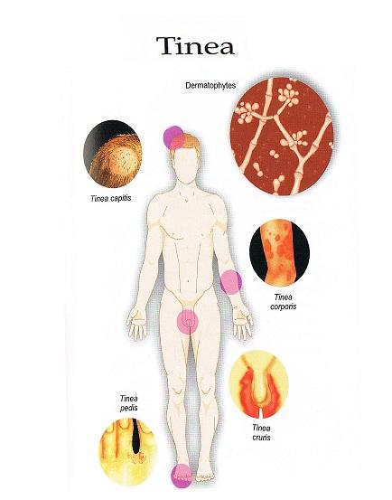 1 Medical Topics - Tinea TINEA (FUNGAL) INFECTION Tinea infection There are 3 main groups of fungal organisms that can cause skin infections. They include dermatophytes, yeast and moulds.