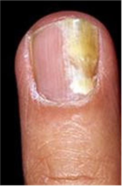 hyperkeratosis (thickening of nail plate) and onycholysis (separation of