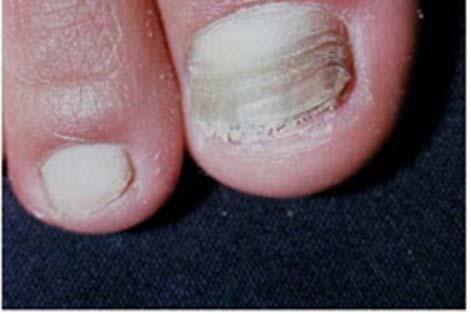 plate without thickening or lifting of nail plate.