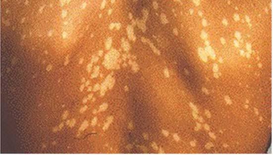It commonly occurs in teenagers and young adults with average onset age of 15-24 years old. Causes: Pityriasis Versicolor is caused by the fungus Malassezia Furfur.