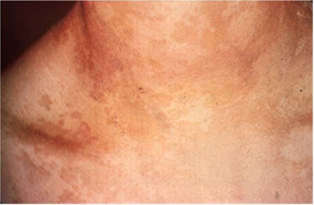 19 Medical Topics - Tinea Treatment: It is caused by fungus so treatment involves topical antifungal (azole creams and