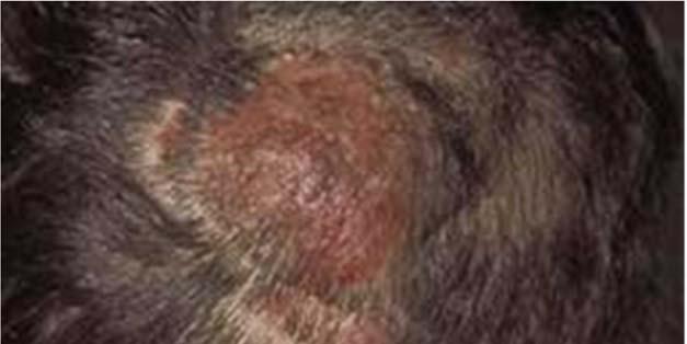2 Medical Topics - Tinea Tinea Capitis (Head) Tinea Capitis refer to a dermatophytes (fungal) infection of the scalp, eyebrows and eyelashes caused by Trichophyton and Microsporum fungi.