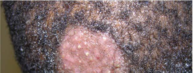dot Tinea capitis (fracture of hair shaft leaving infected dark
