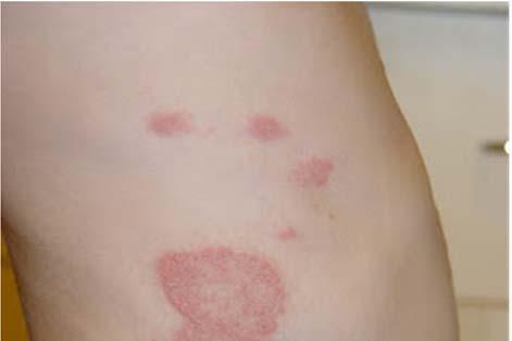 7 Medical Topics - Tinea With continuous inflammation, there may be