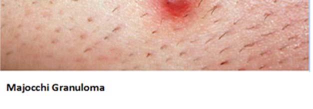 Tinea imbricata is caused by T.
