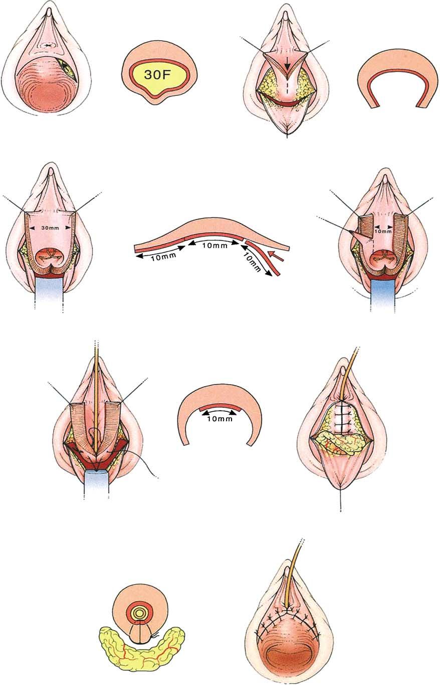 C.R. Chapple / EAU Update Series 1 (2003) 178 185 181 Fig. 5. Principles of Young Dees urethral tailoring (reduction sphincteroplasty).