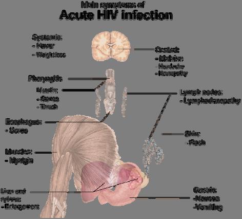 Acute Infection Symptoms Source: http://upload.wikimedia.org/wikipedia/commons/thumb/4/4a/symptoms_of_acute_hiv_infection.