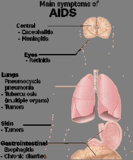AIDS Symptoms Source: