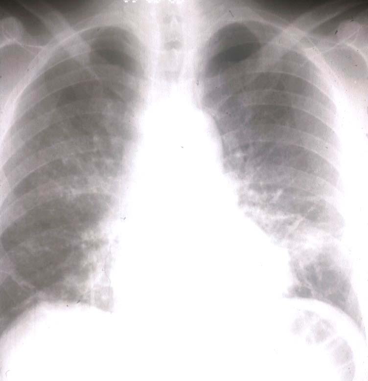 Pneumocystis jirovecii pneumonia (PCP) Leading AIDS defining opportunistic infection in UK Caused by the pneumocystis organism Usually affects patient with a CD4 count lower <200 Cough usually