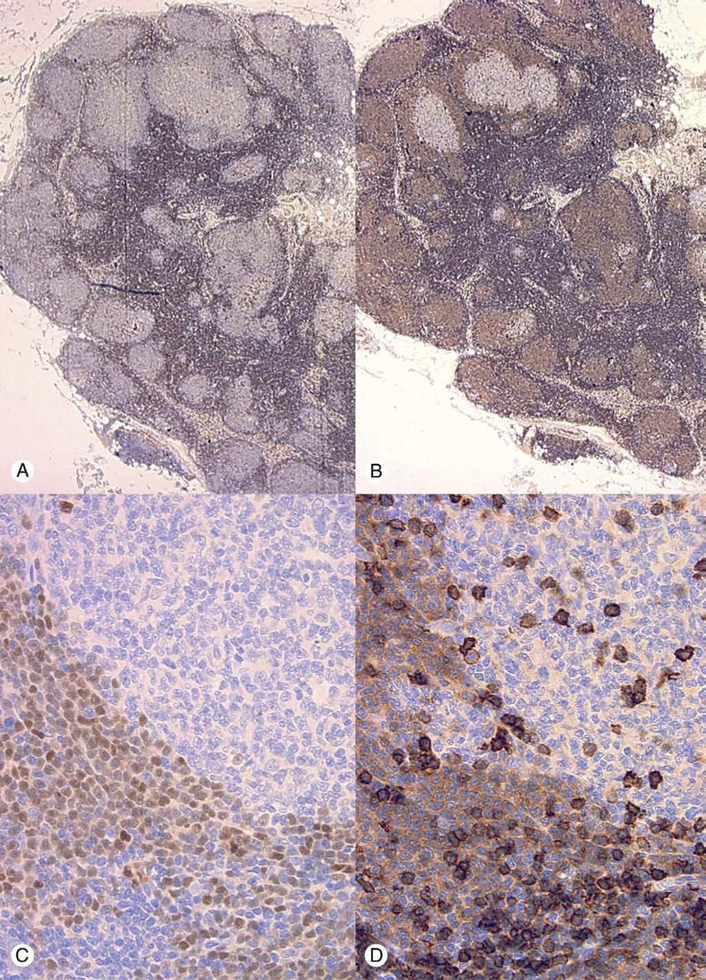 Composite mantle cell and follicular lymphoma 261 Fig. 2 MCL (immunoperoxidase). A and B, Detail from left part of Fig. 1A (original magnification 5 and 100 ).