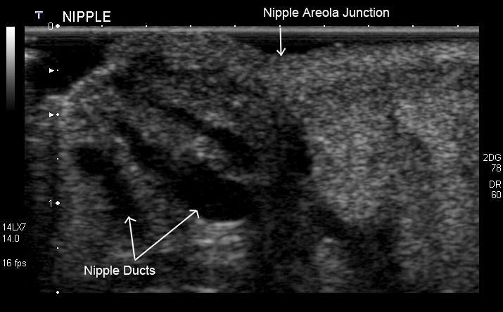 US for NSM Assessment Preoperative ultrasound-guided vacuum-assisted biopsy of ducts beneath NAC 36 nipples
