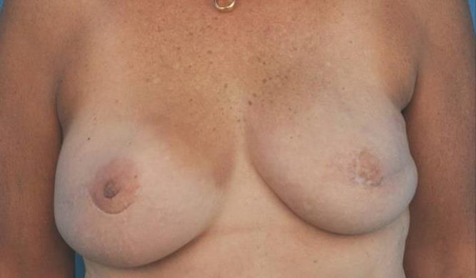 Nipple Loss Management Local wound care
