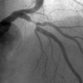 Why Are Bifurcation Lesion More Prone to Thrombosis Pathological studies suggest that arterial branch points are foci of low