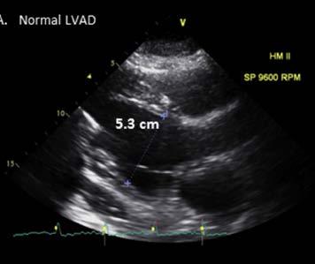 Echocardiography for Device
