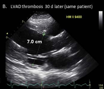 LVIDd after LVAD thrombosis