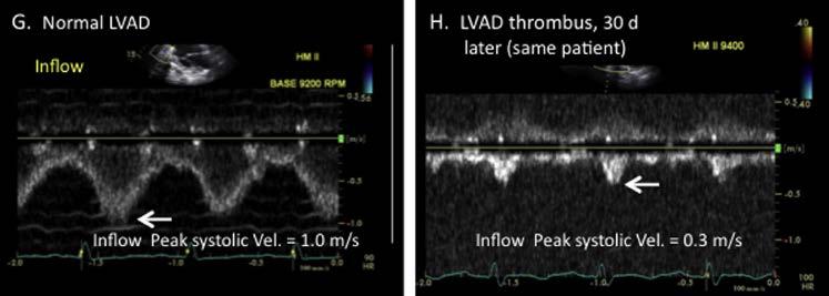 Echocardiography Ramp Test - Diagnosis of Device Thrombosis Low Velocity