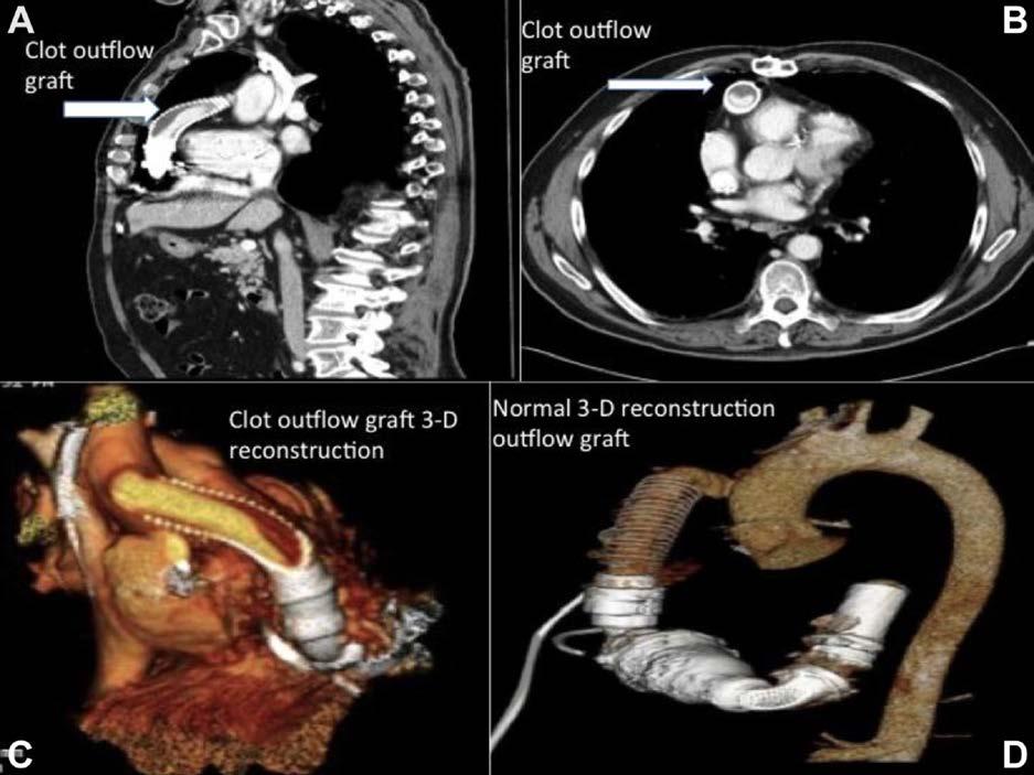 Computed Tomography Angiography (CTA) Mural thrombus in the proximal LVAD