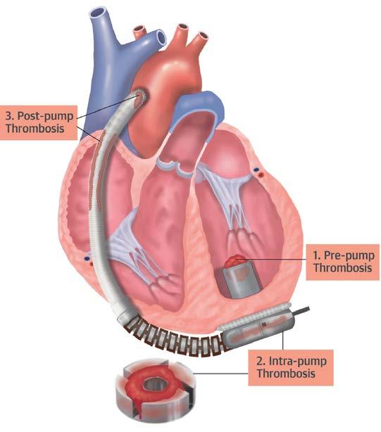 Cardiothorac Surg 2014;3(5);490-495
