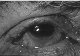 Complications: Anterior Segment Eyelids Conjunctiva Lacrimal system Cornea Iris Sclera Lens Eyelids