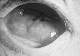 to dry eye Symptomatic in 1 month Opacification in 9-10 months More likely if >30 Gy Dry Eye: Management Aggressive
