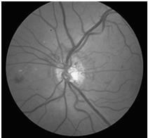 Complications Macular Edema NVE NVD NVI more likely in the angle?