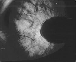 2 years post-radiation May not have retinopathy!