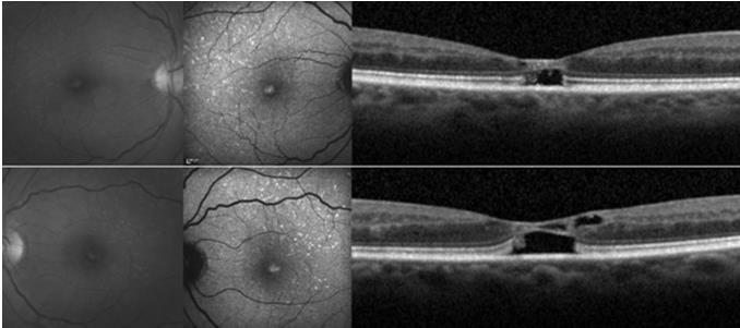 Tamoxifen Retinopathy Pseudocystic foveal cavitation With or without edema With or without crystalline retinopathy Low daily doses Am Journal of Ophthal 167(6) June 2014 Am J Ophthalmol.