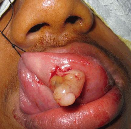 Patient had no difficulty in chewing, swallowing and phonation and there was no sensory or taste abnormalities by the patient. Color of overlying mucosa was normal.