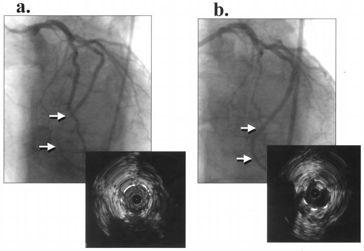 JACC Vol. 38, No. 3, 2001 September 2001:672 9 Adamian et al. Cutting Balloon Angioplasty for In-Stent Restenosis 677 Figure 1.
