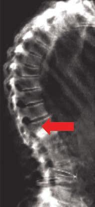 Dual-energy Vertebral Assessment More than 40% of women with