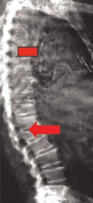 as a lowtrauma fracture of the spine, hip, forearm or ribs.