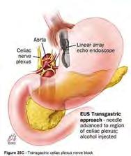 Celiac Plexus Neurolysis (Block) Celiac plexus innervates pancreas