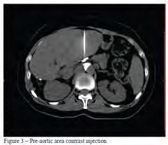 approach Two needles Fluoro or CT Pain anesthesiologist Endoscopic Through