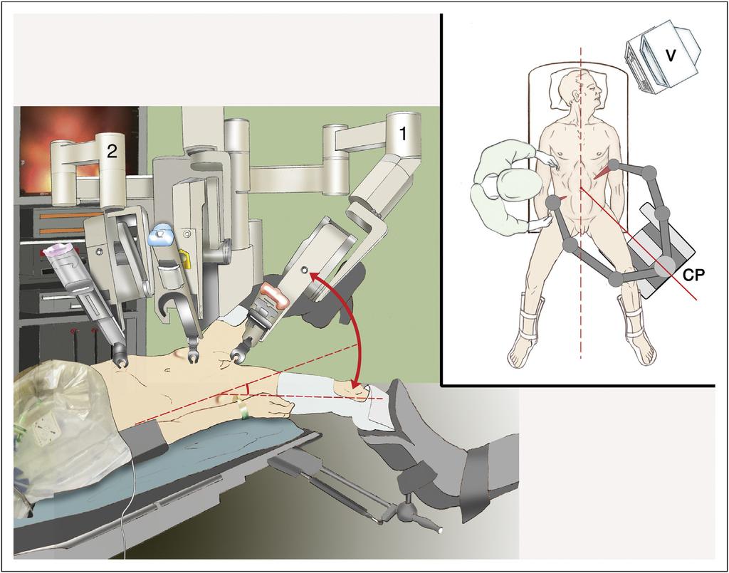 380 A. Valverde et al. 3 Patient installation The patient is positioned in lithotomy position to allow access to both the abdominal cavity and the perineum.