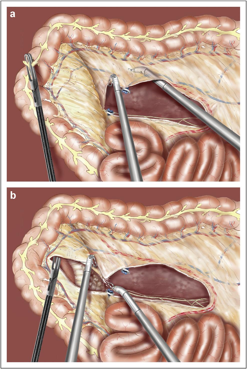 The sequence of operative steps can be performed by progressively approaching each area of dissection in a circular manner, from cephalad caudad and from medial to lateral, leaving the lateral